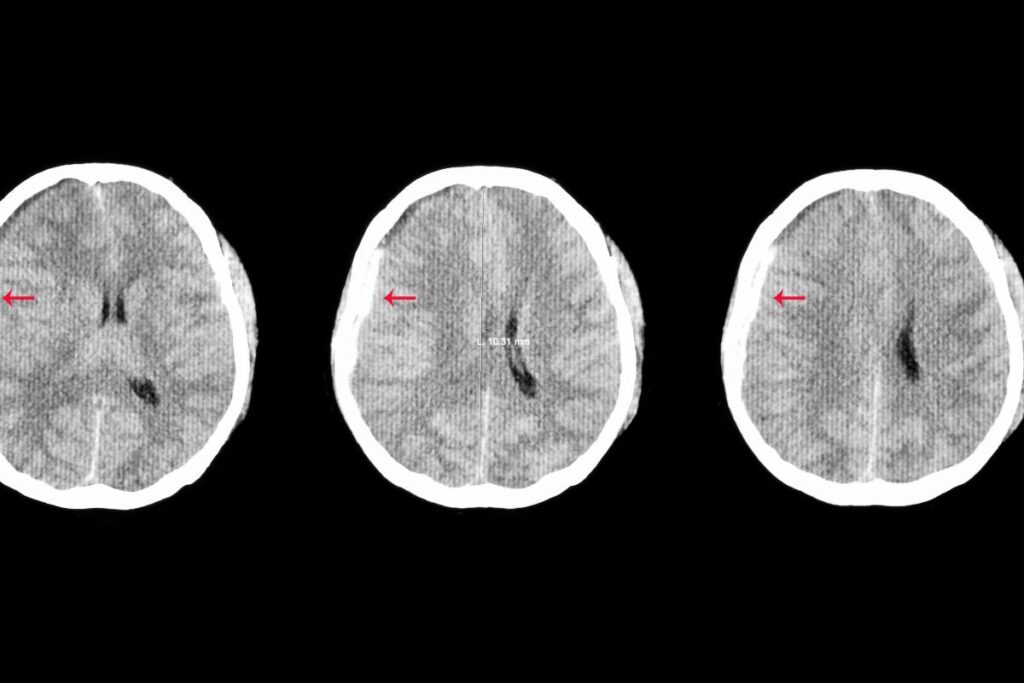 oedeme osseux temps guerison (3)