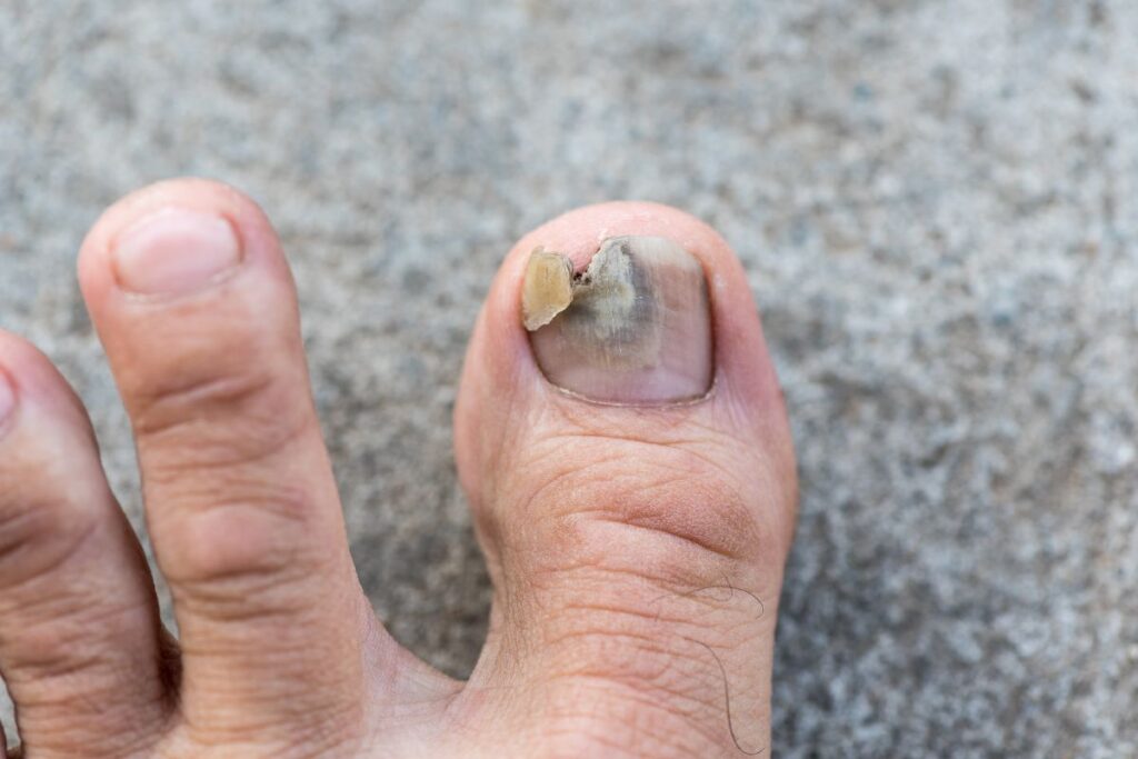 abandon utmb cause (1)